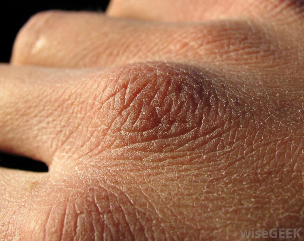 close-view-of-dry-skin-on-hand