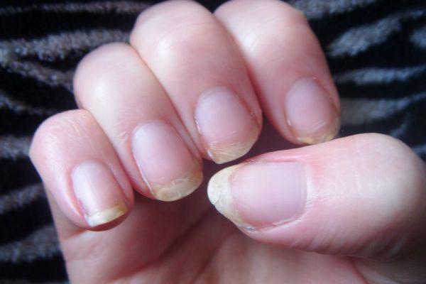 cracked-nails