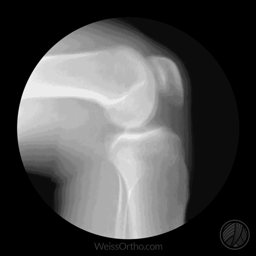rodilla