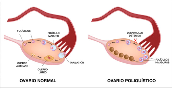 retraso-menstrual