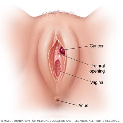 cancer-de-vulva