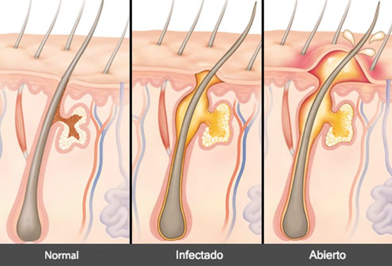 Tenemos el remedio perfecto para quitar granos en la axila