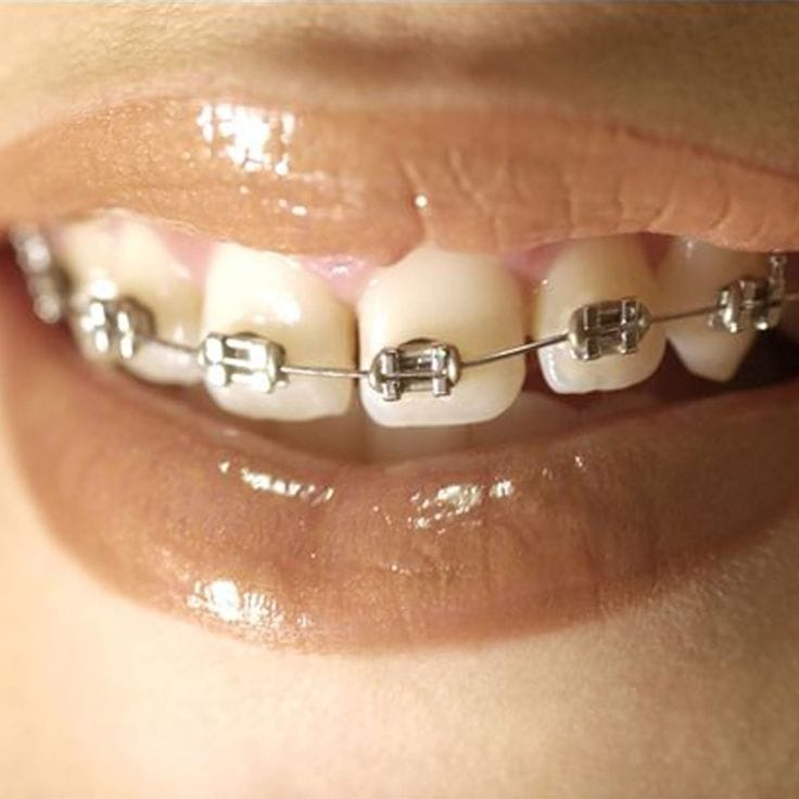 Tips de belleza para mujeres con brackets 2