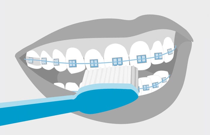 Tips de belleza para mujeres con brackets 0