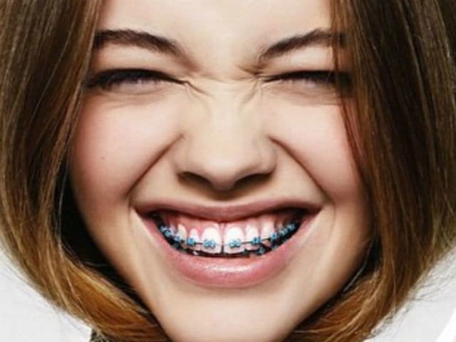 Tips de belleza para mujeres con brackets 6