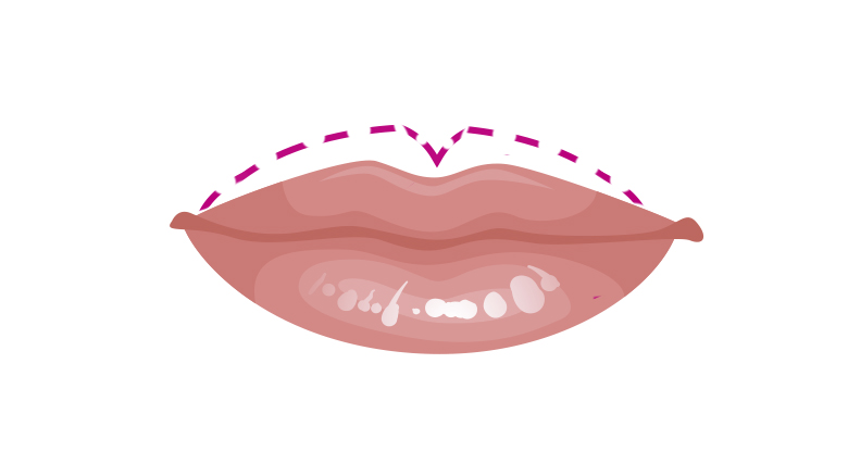 labio grueso superior