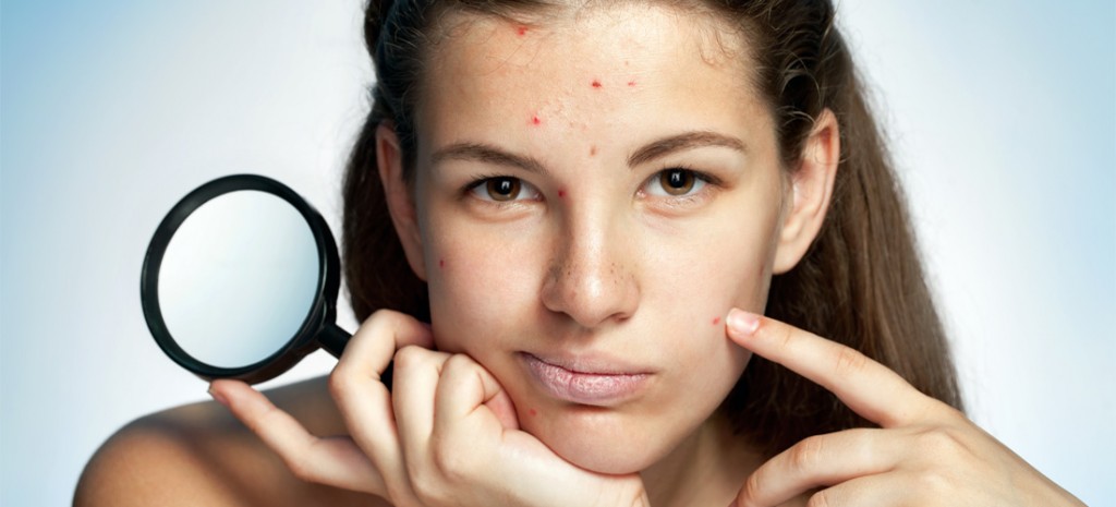 Consejos de maquillaje para piel con acné