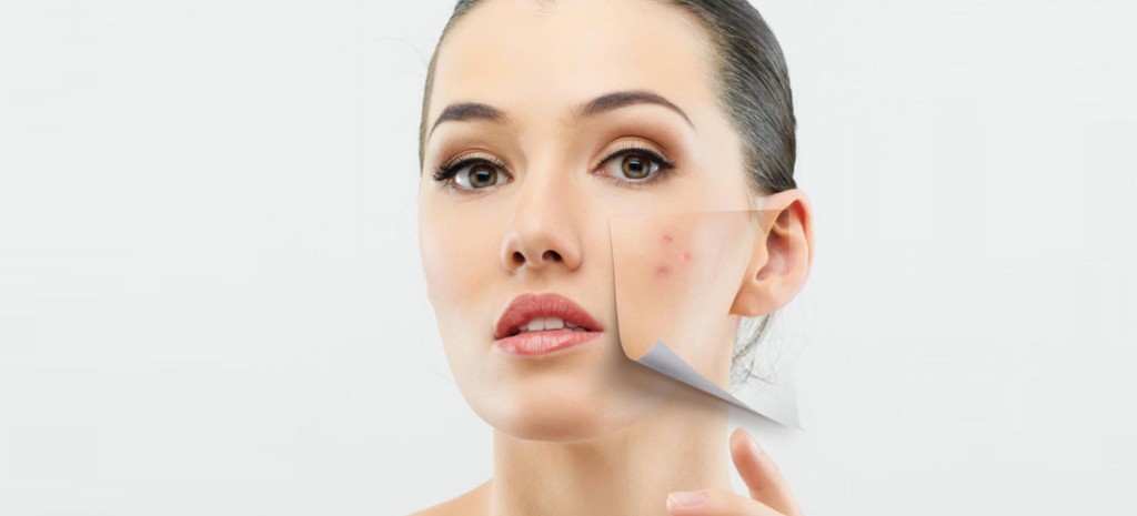 6 causas inesperadas del acné
