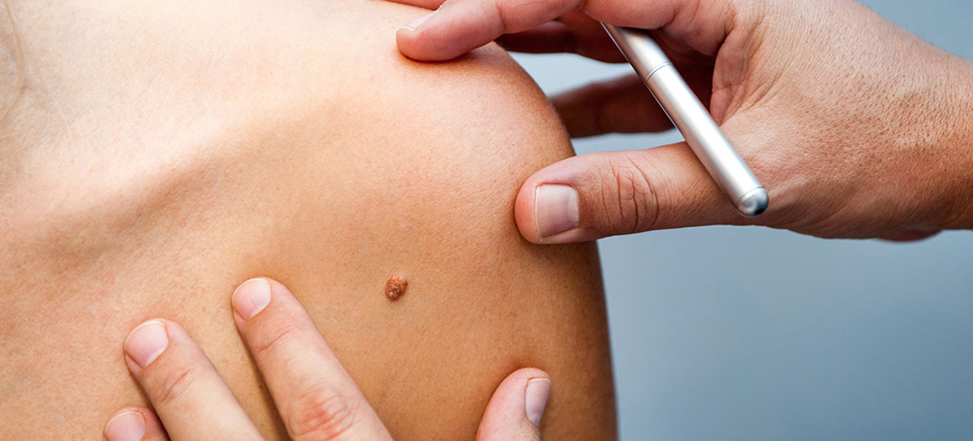 7 remedios naturales para acabar con las verrugas