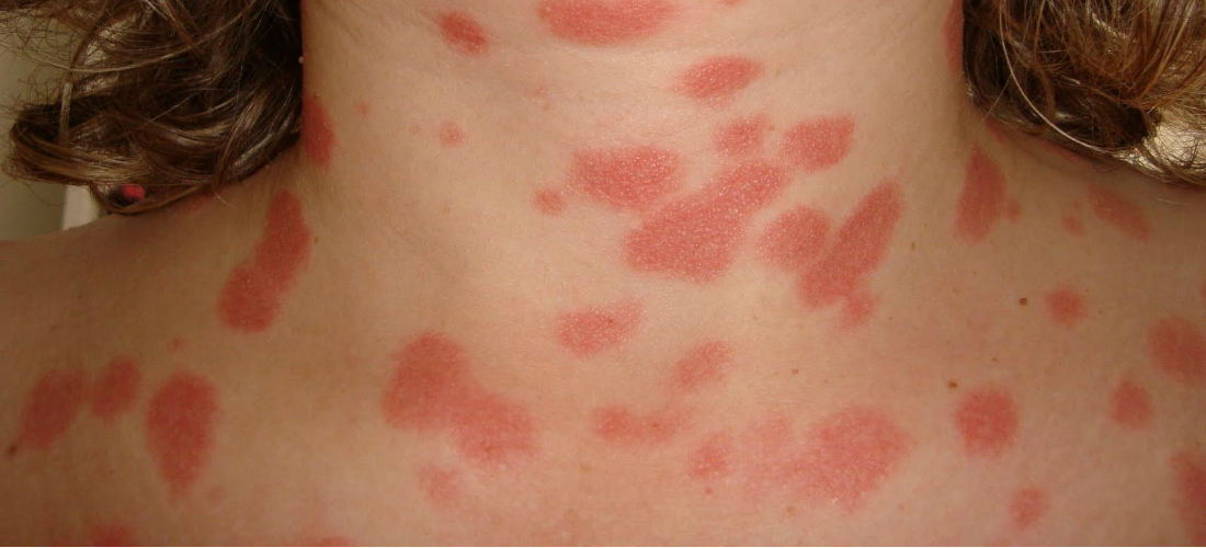 ¿Qué es la psoriasis?