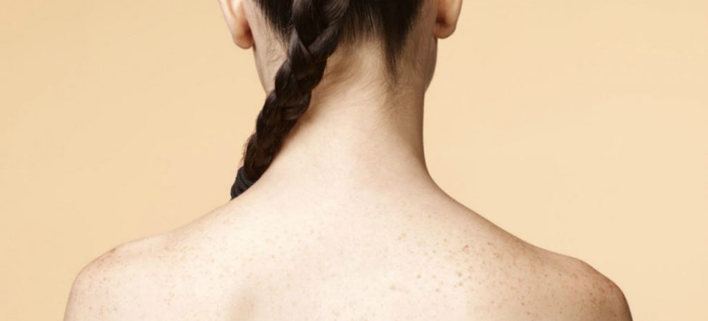 7 tips para eliminar el acné de la espalda como por arte de magia