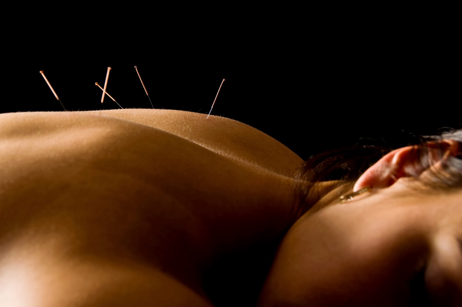 acupuntura (1)