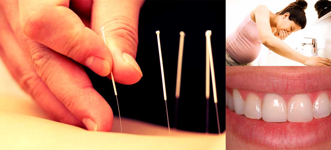 5 cosas que no sabías de la acupuntura