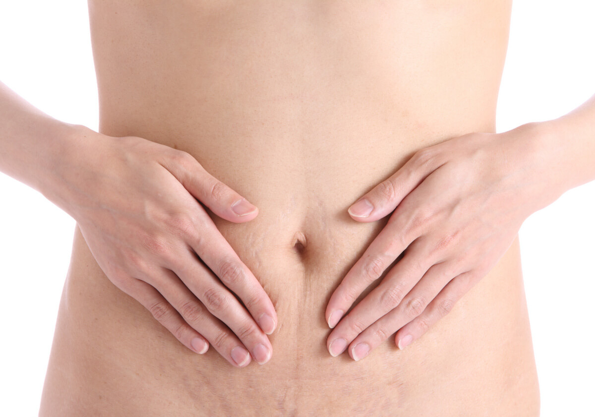 exfoliantes naturales para tratar las estrías1