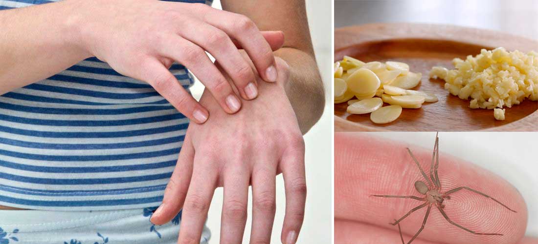 El mejor remedio natural para aliviar ronchas por picaduras