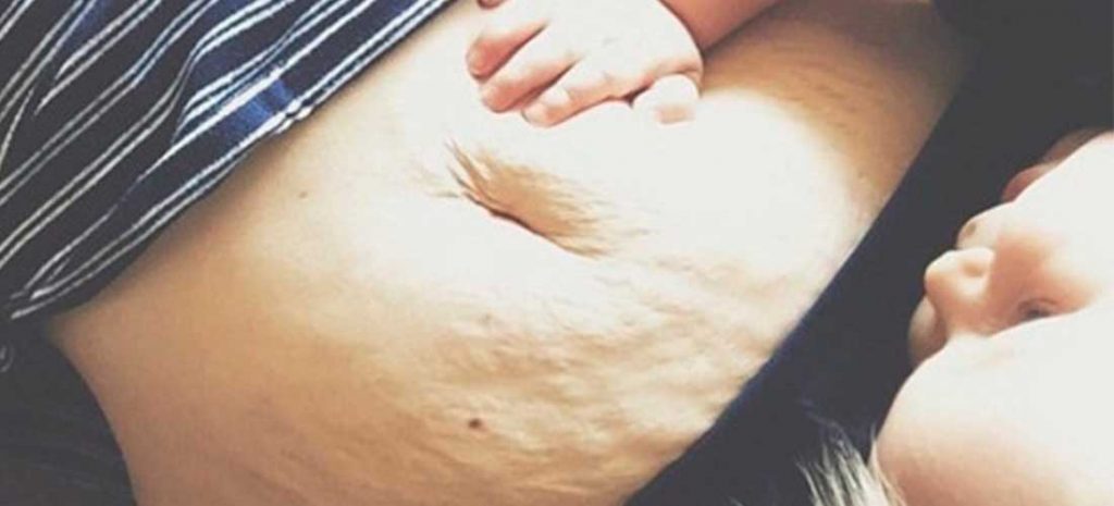 9 trucos para estirar la piel después del embarazo