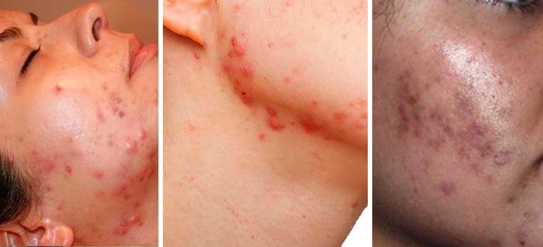 Cómo reducir las cicatrices del acné