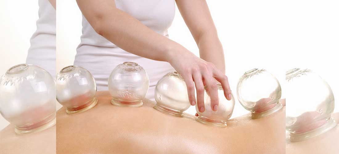 5 beneficios que deberías conocer de la ventosaterapia o cupping