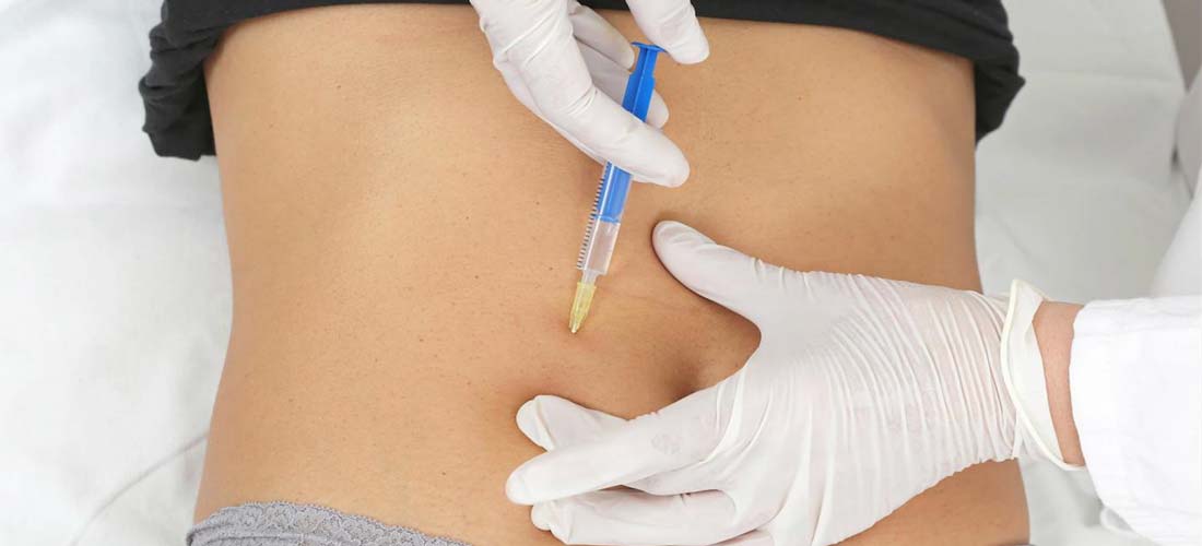Carboxiterapia: el tratamiento que sirve para perder grasa