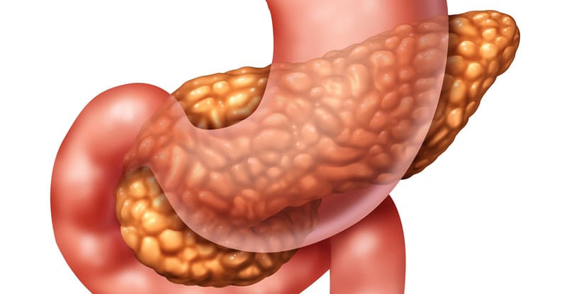 Pancreatitis-inflamacion-pancreas