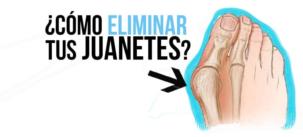 eliminar los juanetes