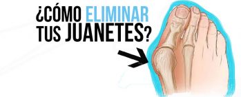 eliminar los juanetes