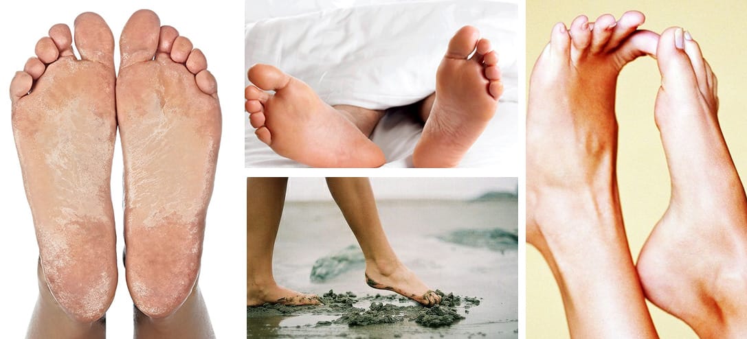 5 Trucos para eliminar los hongos de los pies