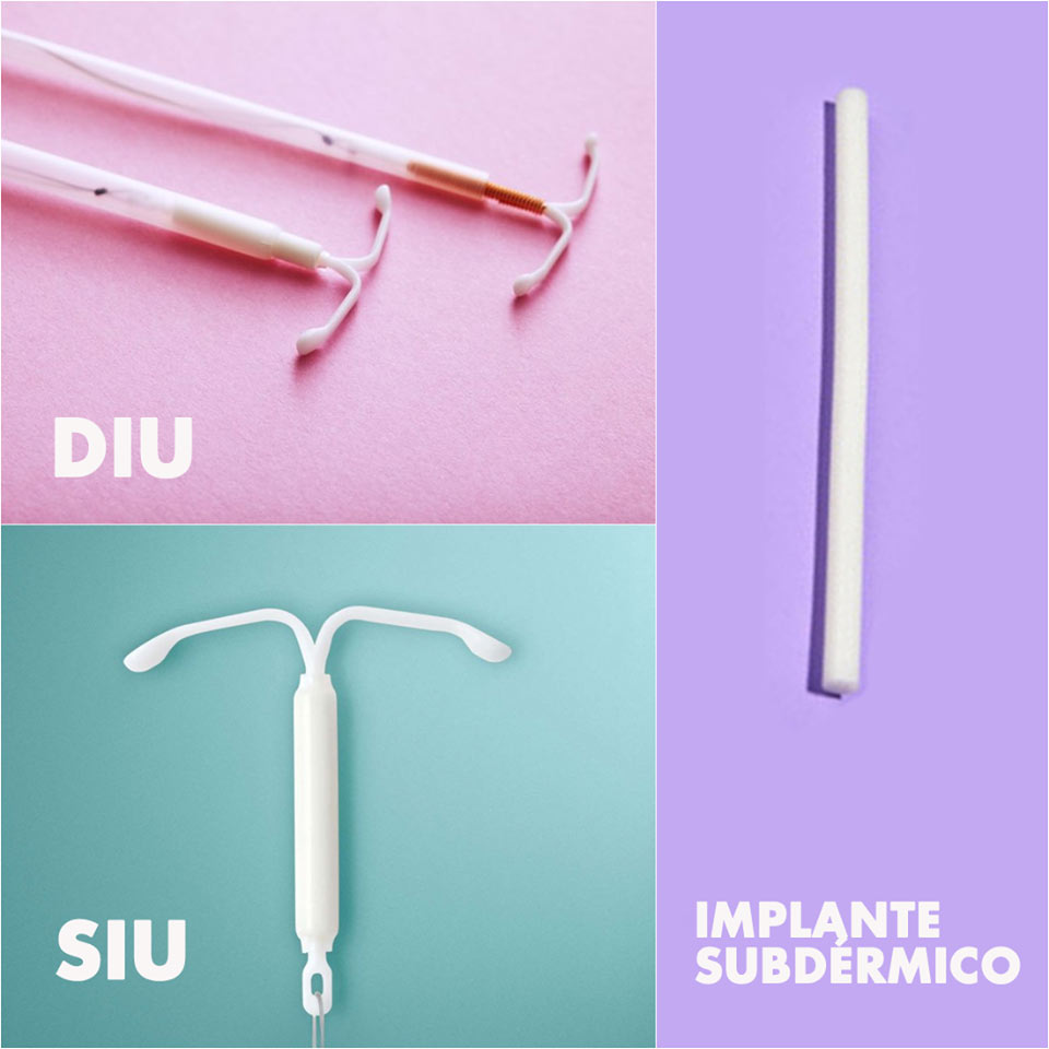 SIU, el nuevo anticonceptivo que muchas mujeres prefieren 0