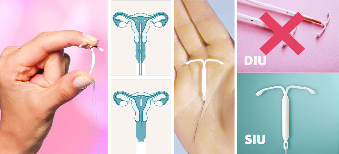 SIU, el nuevo anticonceptivo que muchas mujeres prefieren
