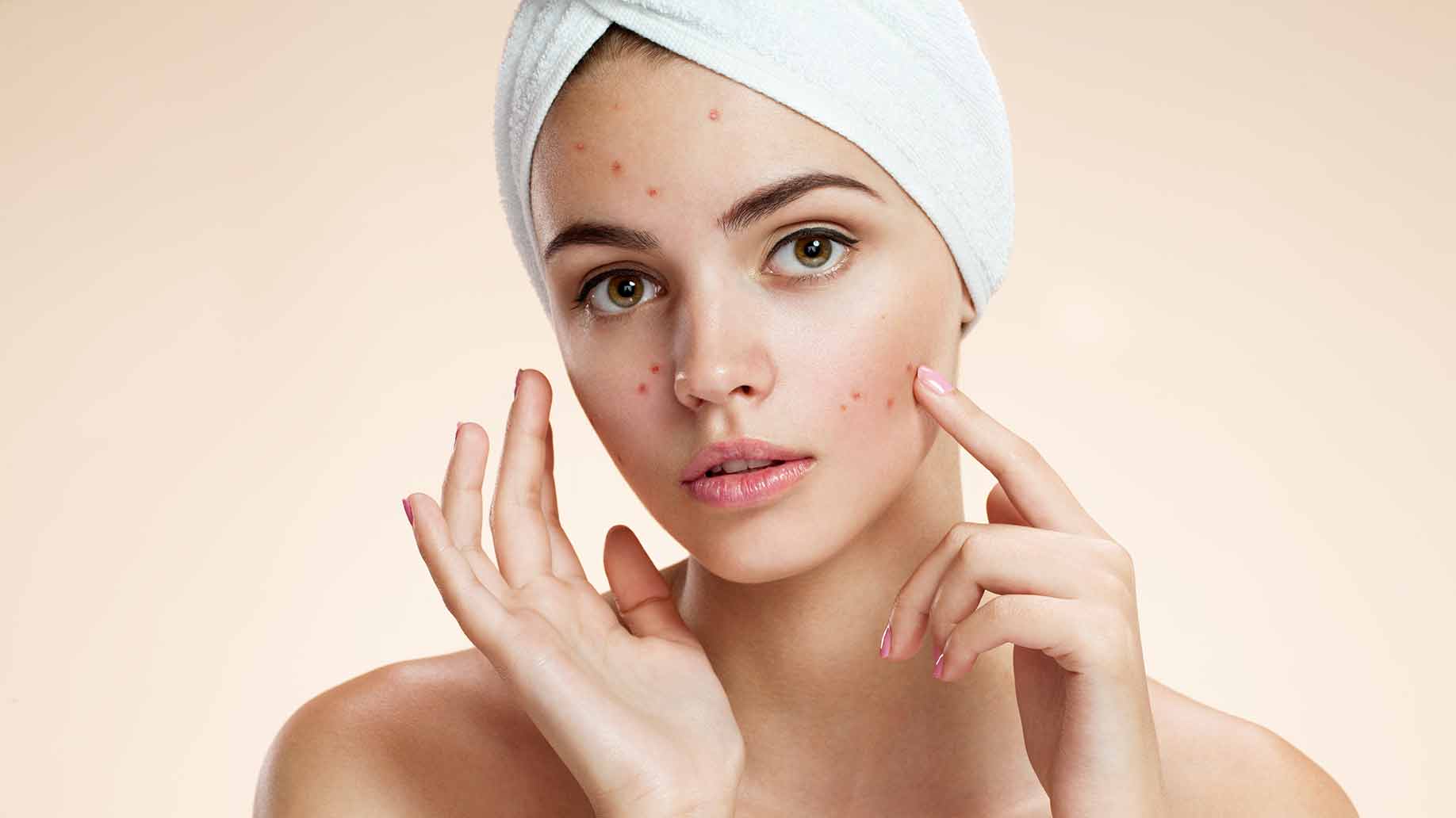 acne-natural-facial-masks-diy-problem-skin