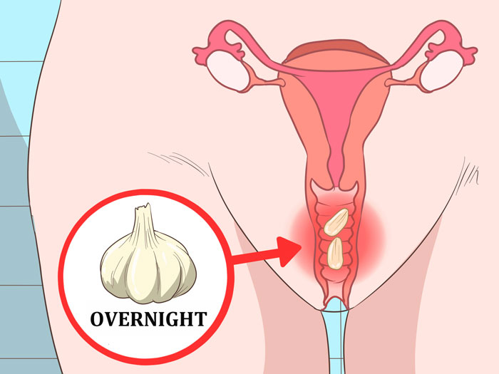 tratamientos-caseros-infecciones-vaginales