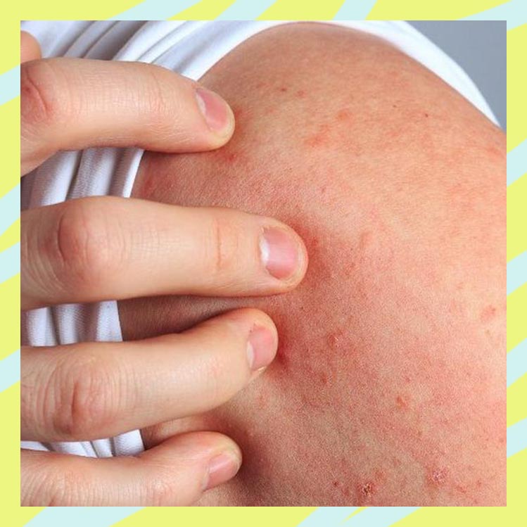 10 remedios caseros para la dermatitis atópica