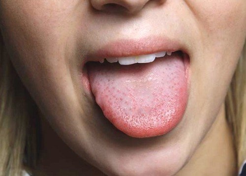 ¿Por qué nos salen granos en la lengua? 1
