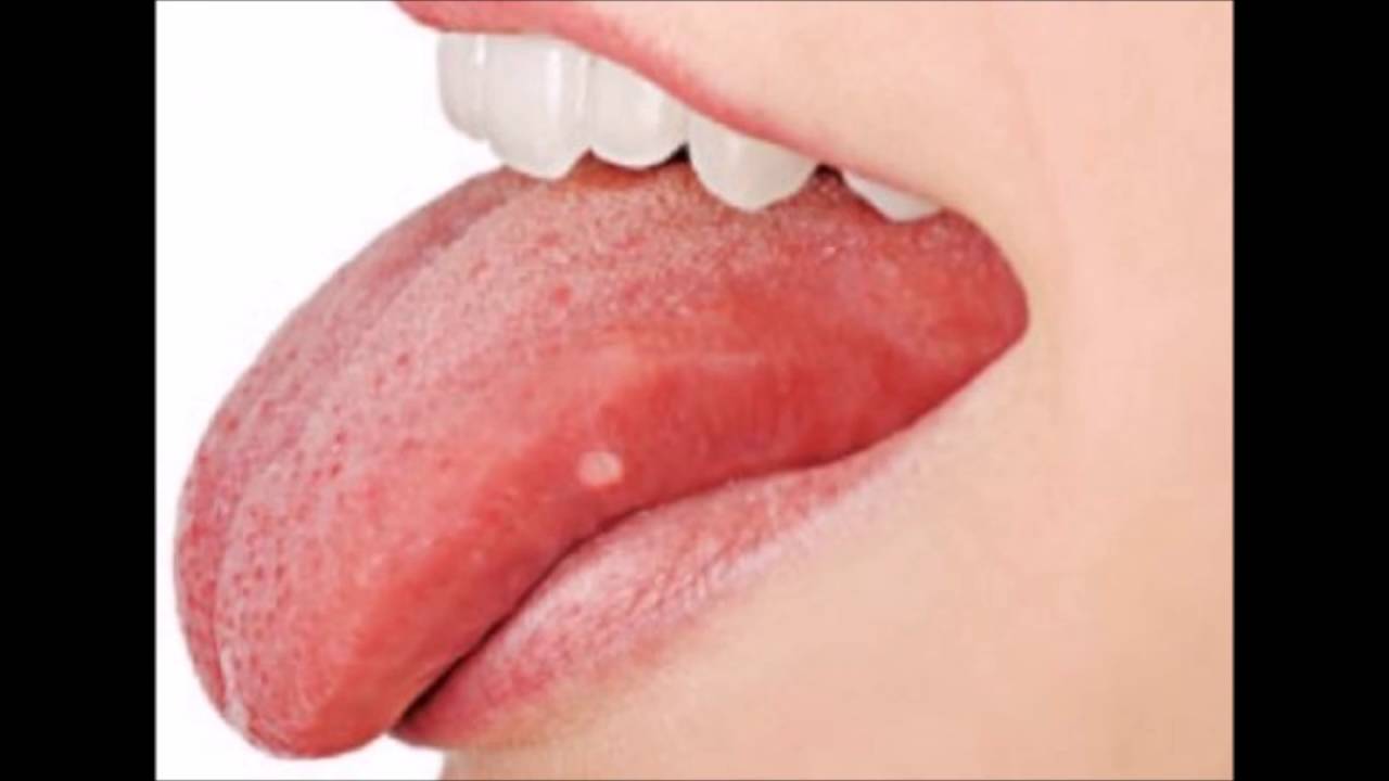 ¿Por qué nos salen granos en la lengua? 2