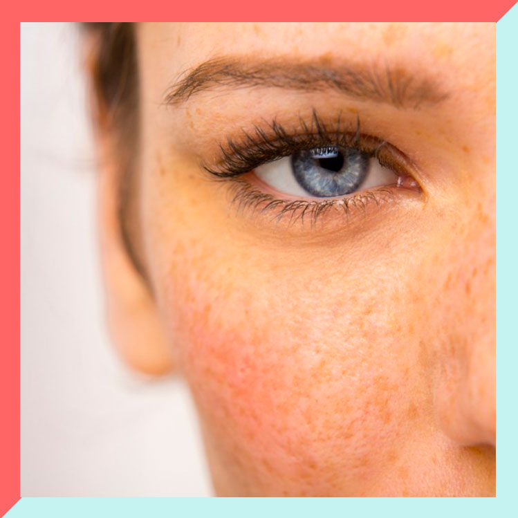 7 tipos de manchas en la piel y cómo eliminarlas de tu rostro