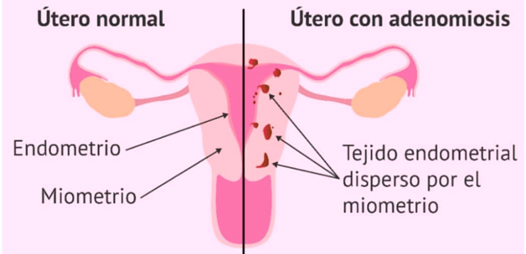 dibujo de utero con adenomiosis