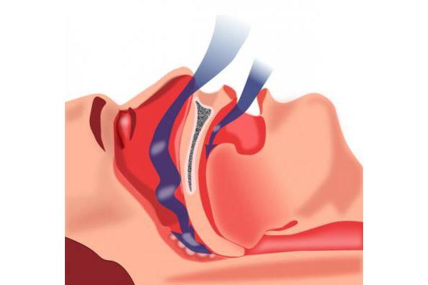 apnea obstructiva ilustracion vias respiratorias