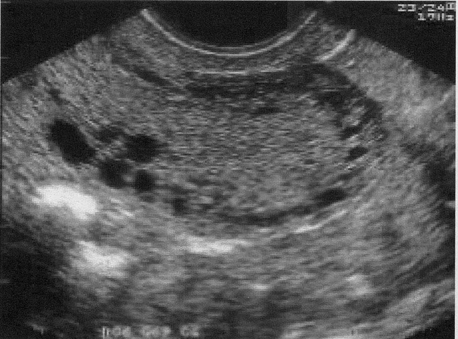 ecografia de utero con adenomiosis
