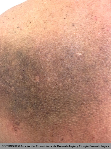 Asociación Colombiana de Dermatología y Cirugía Dermatológica.