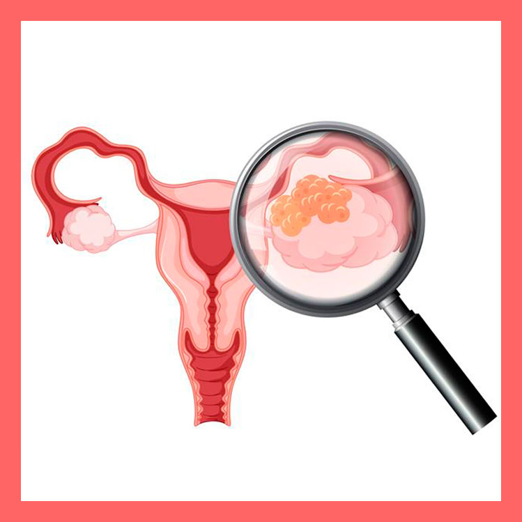 10 síntomas del cáncer de ovario que podrían pasar desapercibidos