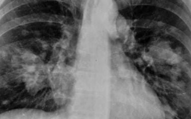 7 síntomas tempranos que pueden significar cáncer de pulmón 5