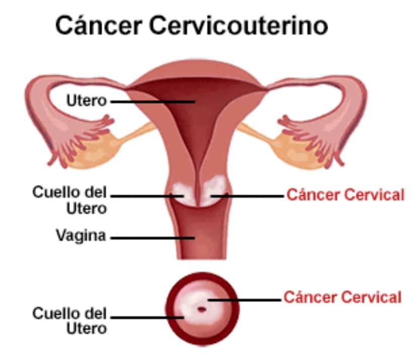 ilustracion de cancer cervicouterino