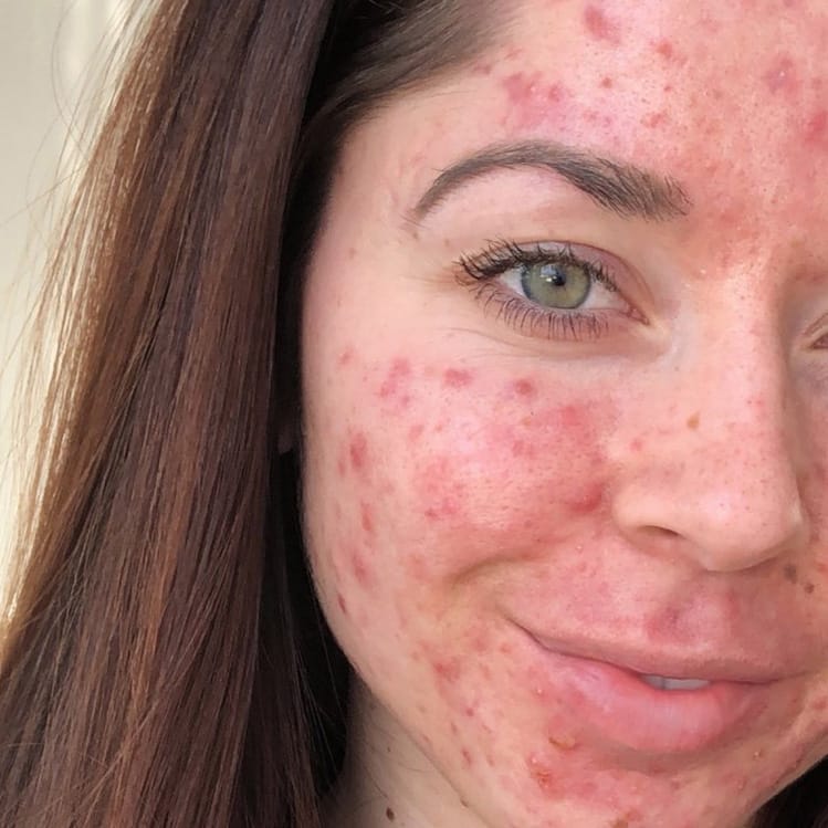 Las mejores y más efectivas 4 cremas faciales para chicas con acné