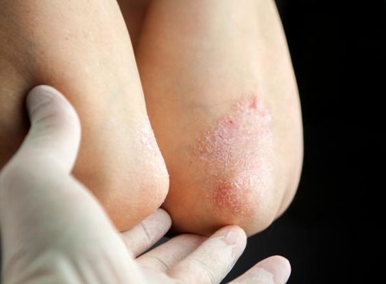 ¿Cómo atacar la dermatitis atópica? 1