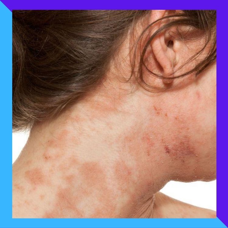 ¿Cómo atacar la dermatitis atópica?