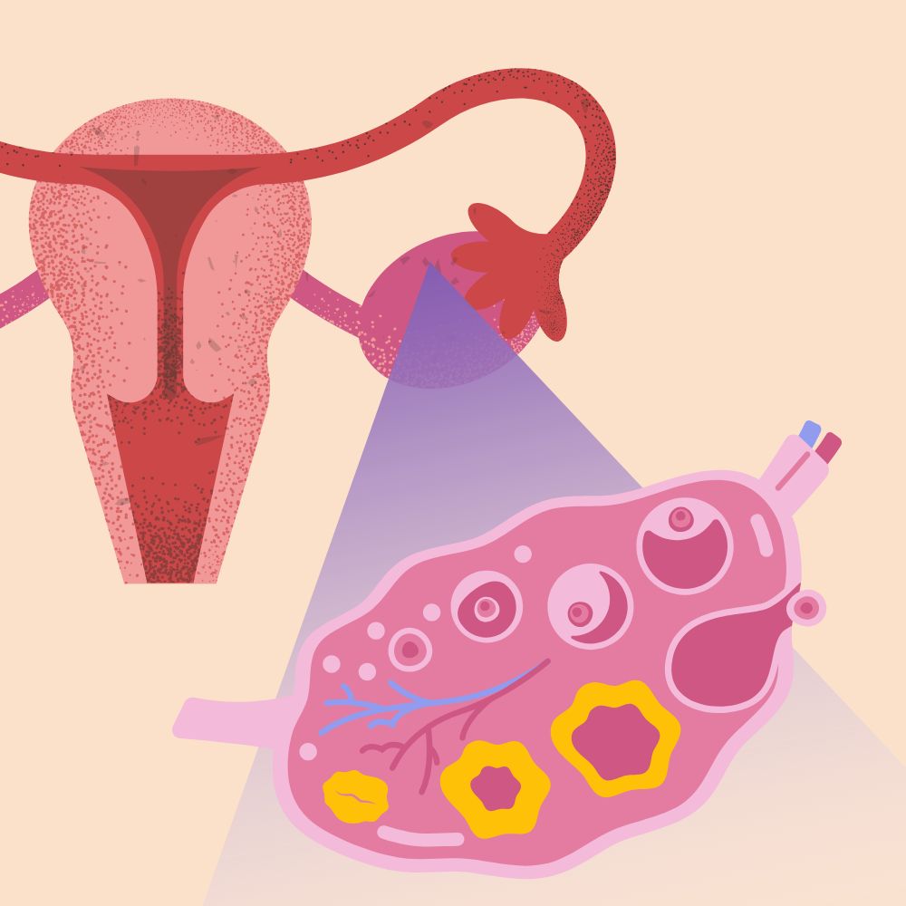 complicaciones del síndrome de ovario poliquístico