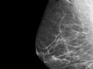 El cáncer de mama puede ser diagnosticado por IA