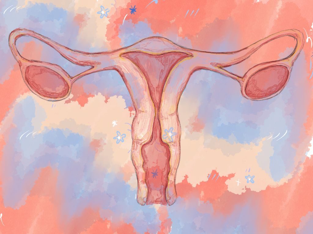 síndrome de ovario poliquístico qué es