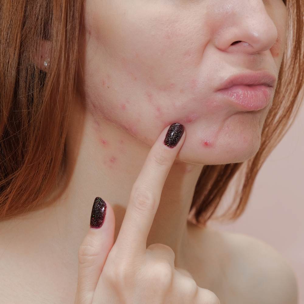 factores que generan acné hormonal