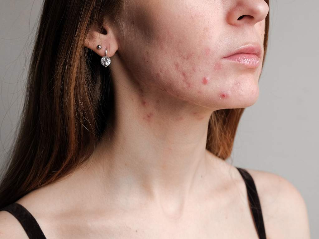 ¿Qué es el acné hormonal y cuáles son sus principales causas?